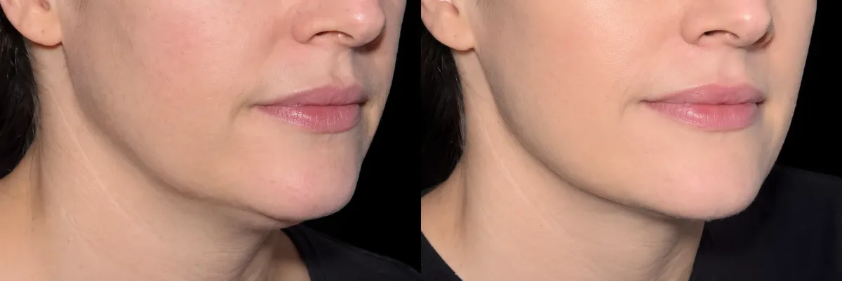 Emface before and after