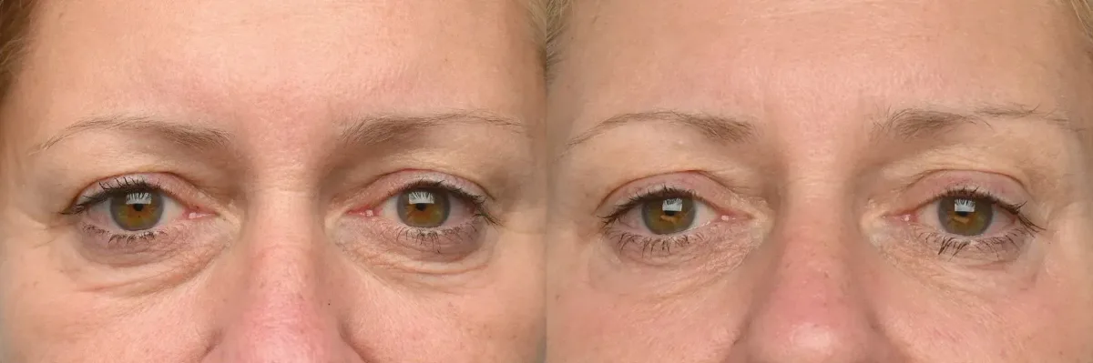 Emface before and after