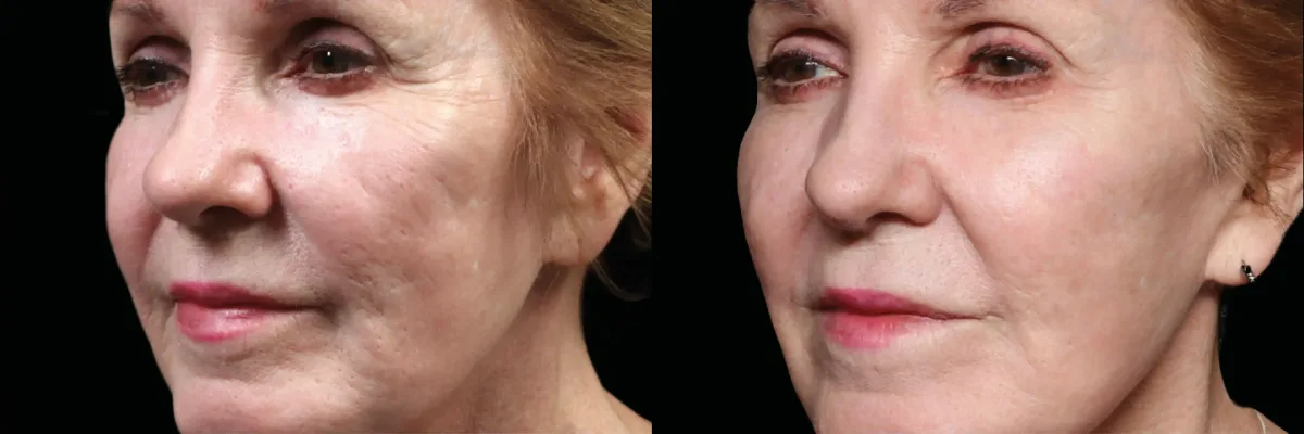 Exion before and after