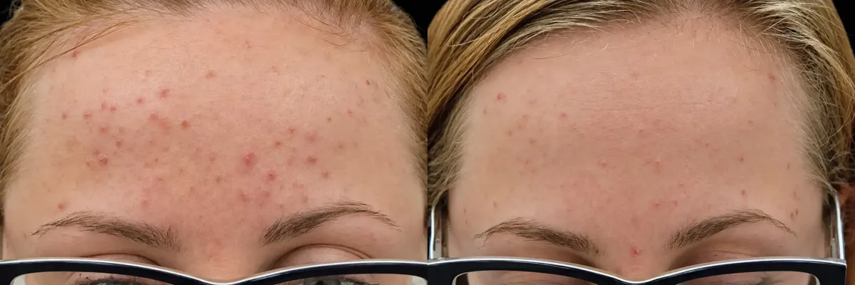 Exion before and after