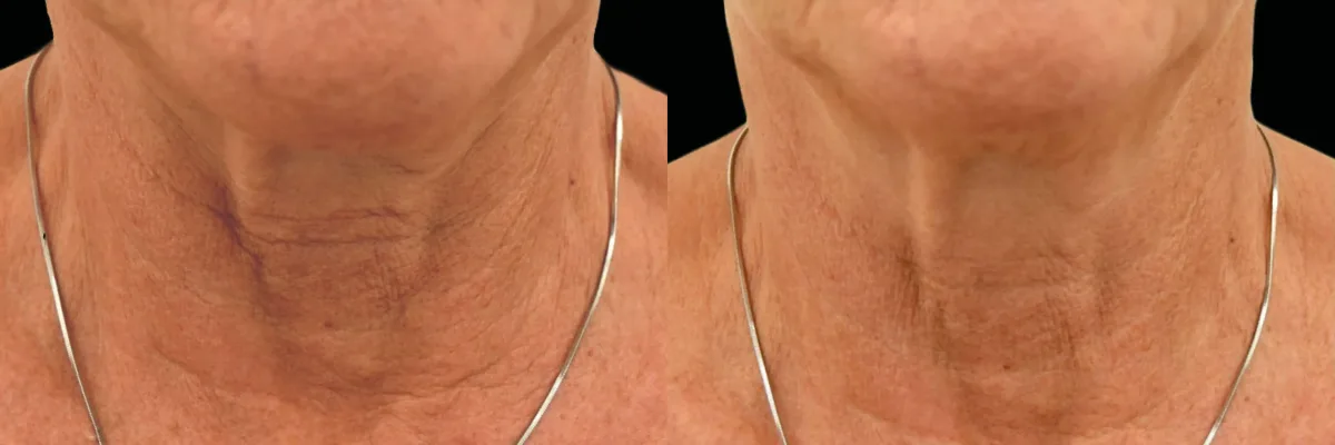 Exion before and after