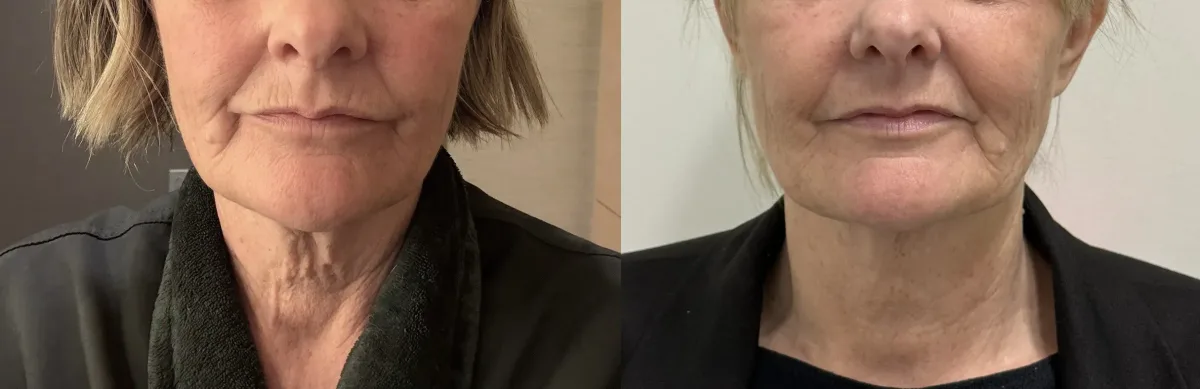 Exion before and after